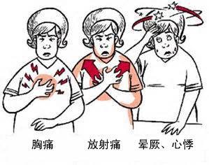 冠心病有哪些癥狀？(圖1)