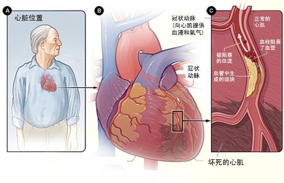 怎樣治療冠心??？(圖3)